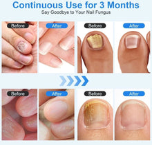 Load image into Gallery viewer, Nail Fungus Laser Device Toe Nail Fungus Treatment